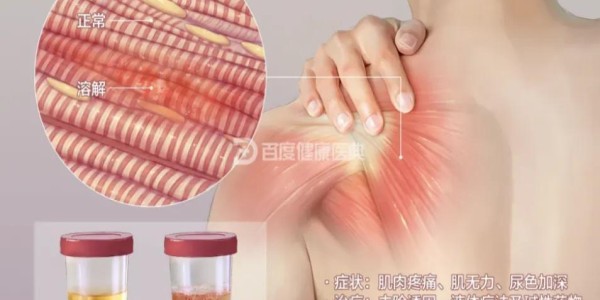 kaiyun-警惕！小心这些药正在“溶解”你的肌肉